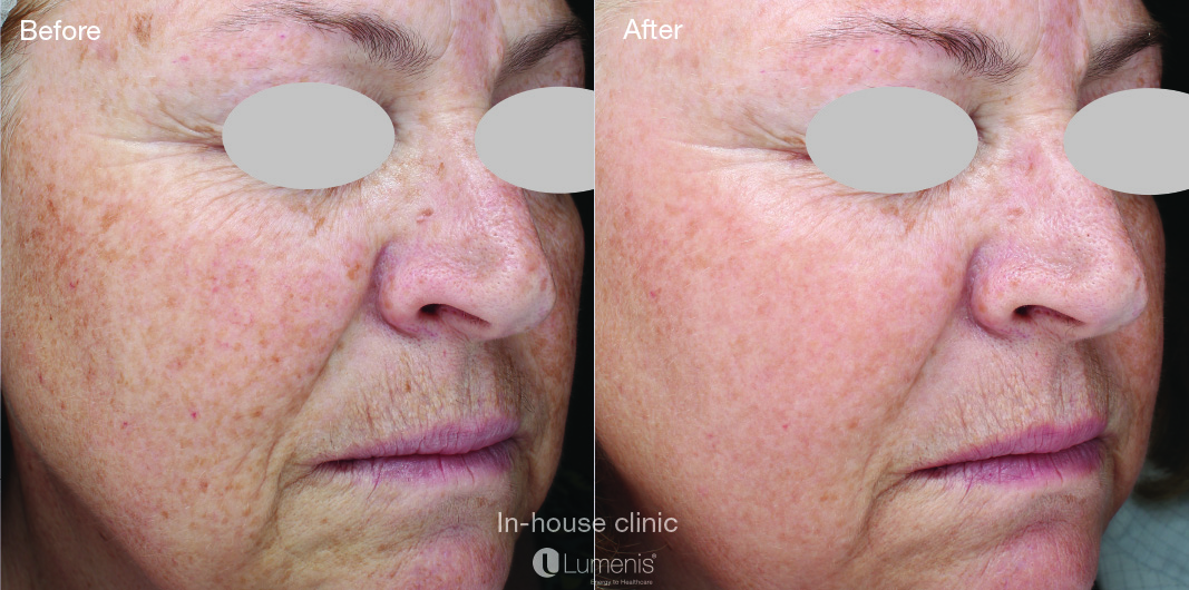Before and after treatment with Photofabulous from Lumenis 